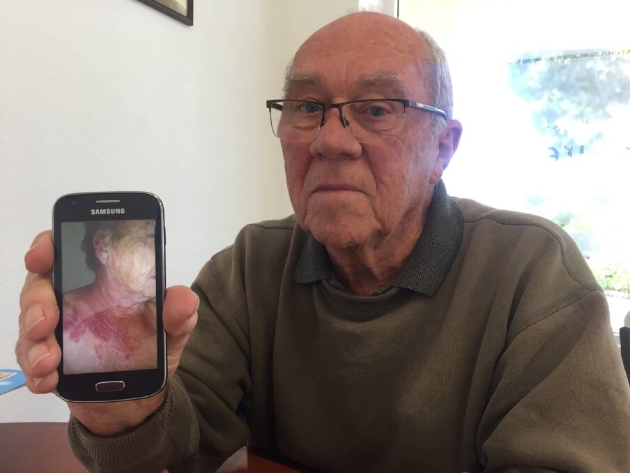 Barry Thompson feels for his wife, Catherine, who was struck down with shingles in May. He is holding a photo of Catherine's shingles rash, which blistered. 