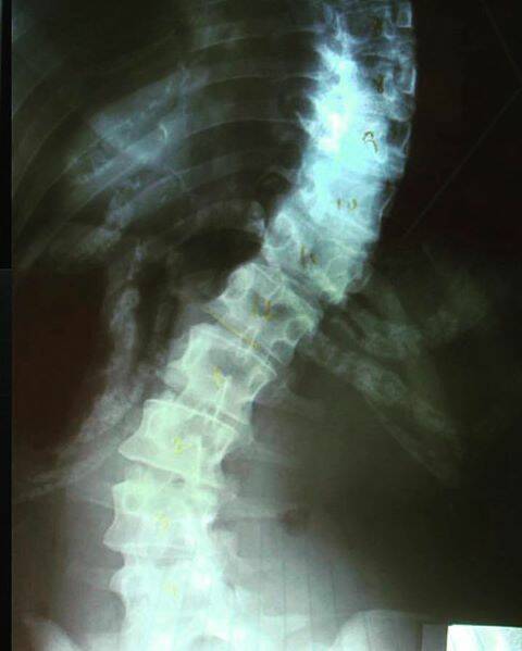 Parents: Don't depend on schools to detect scoliosis in kids
